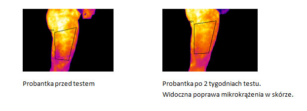 Lirene Walcz z Cellulitem Sekret Urody